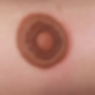 images of ringworm