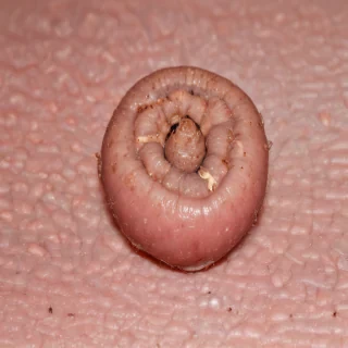 images of ringworm