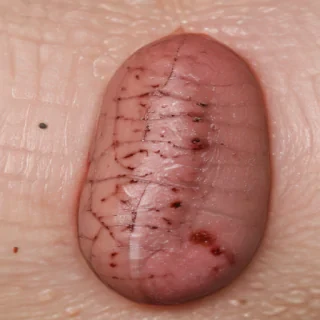 images of ringworm