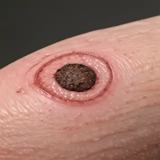 images of ringworm