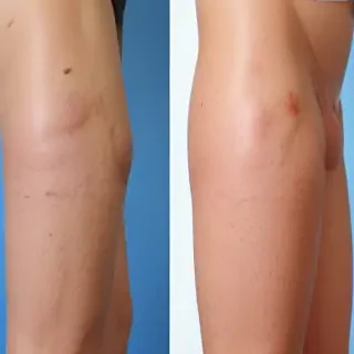 hemorrhoids pictures