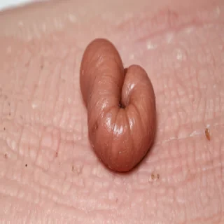 images of ringworm