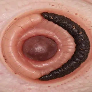 images of ringworm
