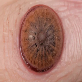images of ringworm